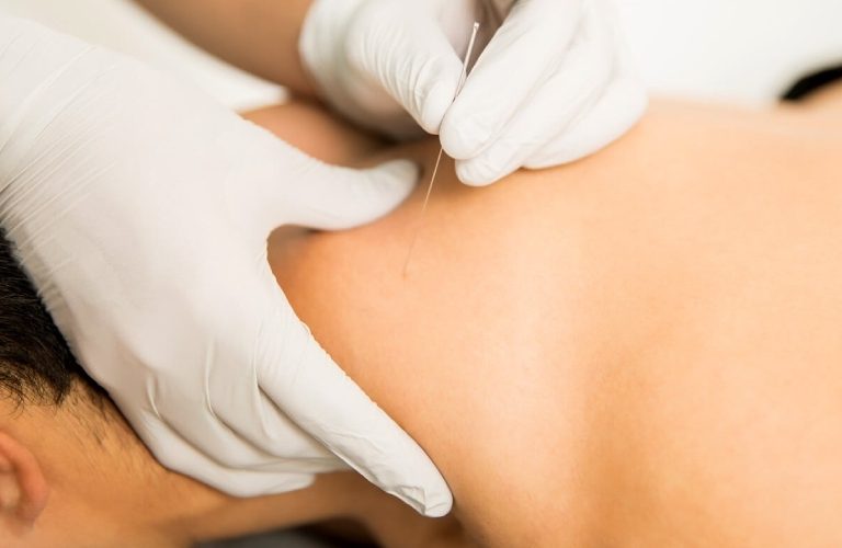 6 Reasons Why Dry Needling Therapy is Beneficial
