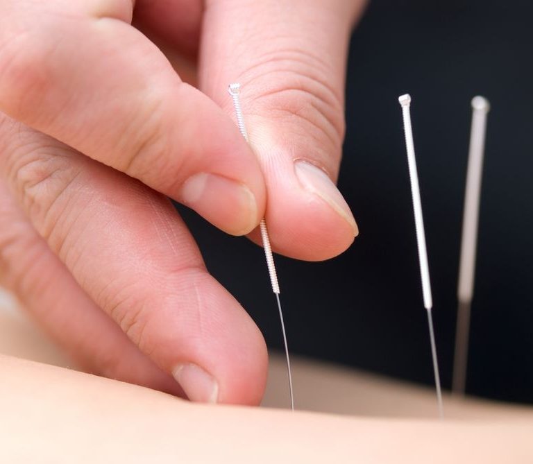Treat Your Tennis Elbow With Acupuncture.